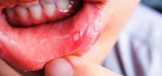 Mouth Ulcers