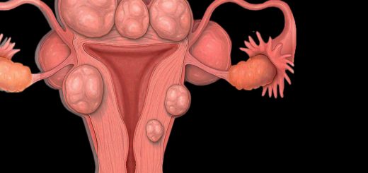 fibroids1