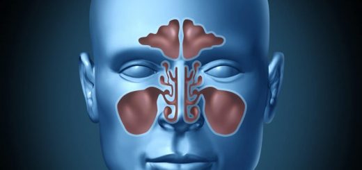 Sinusitis1