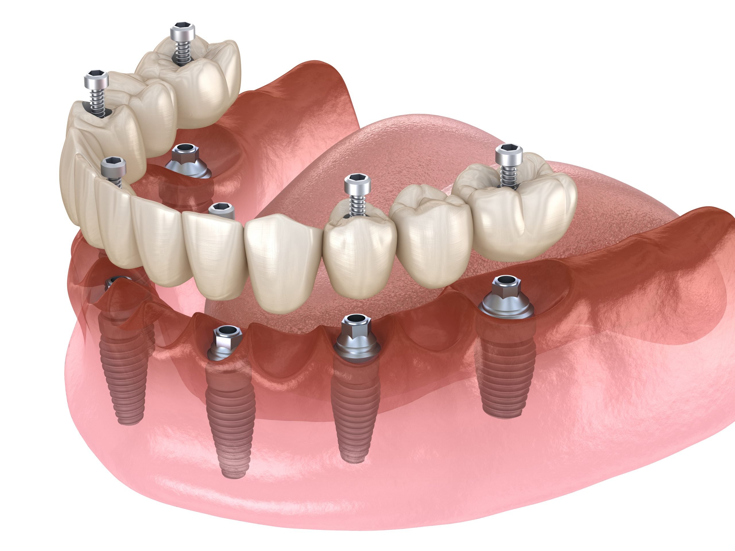 Implant3