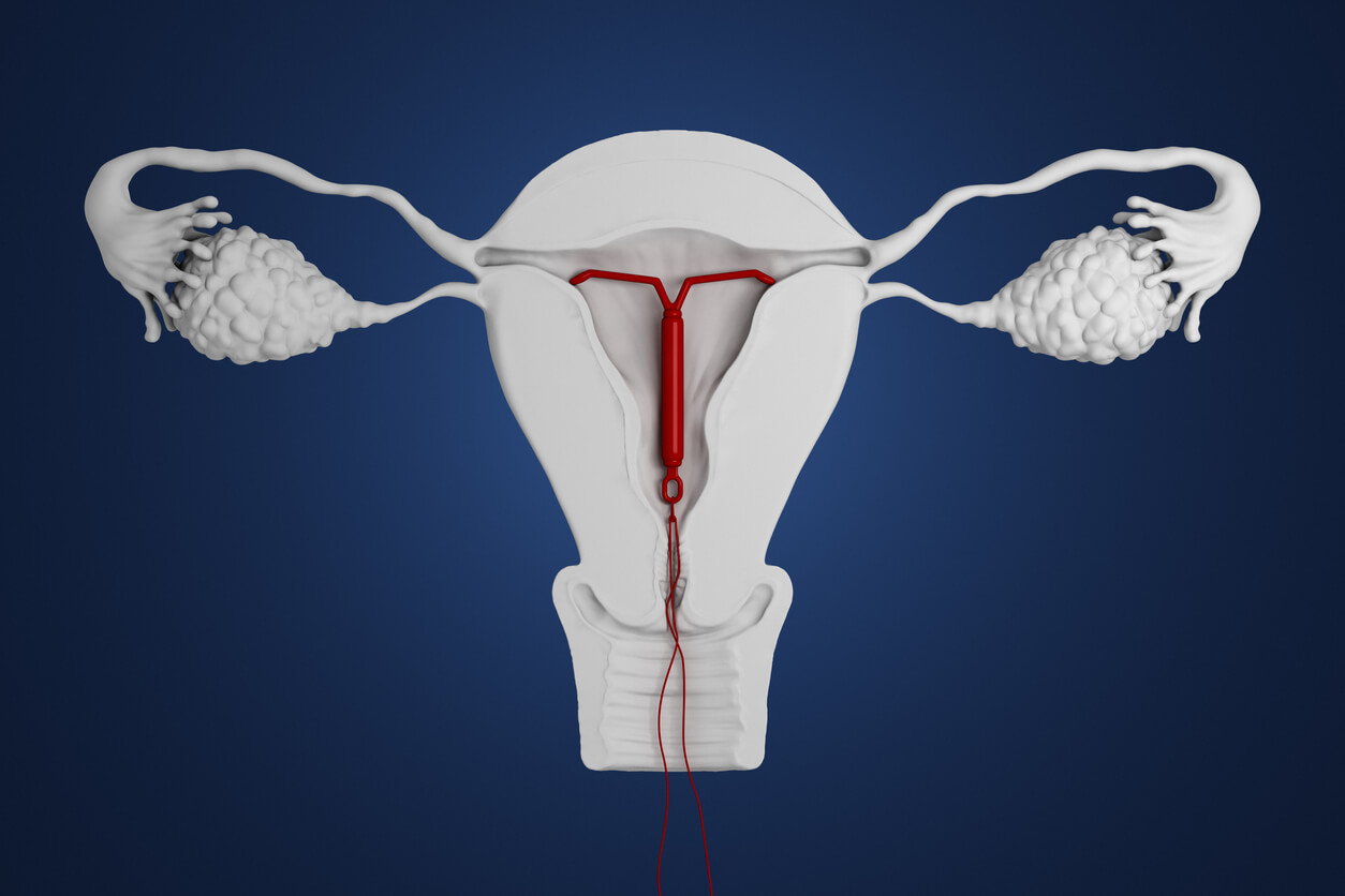 IUD2