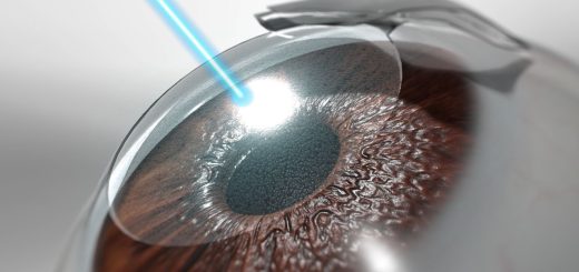 Lasik1