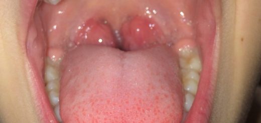 Tonsil1